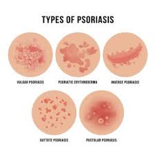 Image result for psoriasis