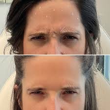 Before and after Botox✨ 10 days between these photos and you can already  see a huge difference!