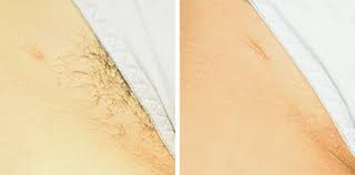 The cost of bikini or brazilian laser hair removal will vary depending on the skincare center or spa, the doctor or technician performing the procedure, the region of the country in which you live, and the total number of treatments you'll require for complete removal. Laser Hair Removal For Transgender People