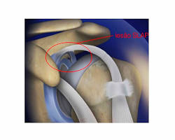 Imagem de Lesão do labrum no ombro