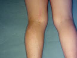 Birthmark On Leg Meaning In Hindi Lichen Striatus Dermnet Nz