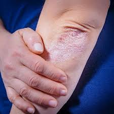 Psoriase Doenca Cronica Que Afasta Pacientes De Vida Normal No Brasil 31 05 2019 Uol Vivabem