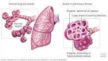 Image result for when lung is patch of no success what is treatment