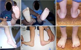 Maybe you would like to learn more about one of these? Pdf Ponseti Method Does Age At The Beginning Of Treatment Make A Difference Semantic Scholar