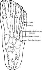 Image result for Metatarsal