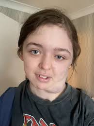 Girl, 14, has 'mole' misdiagnosed three times before devastating condition  confirmed