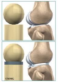 During a game, if the ball hits an elephant, that's fine. Patient Education Concord Orthopaedics