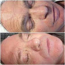 Maybe you would like to learn more about one of these? Hifu Ultraschall Lifting Beauty Bonn Pureline Elke Munzer