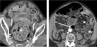 Ct scans and mris are used more often. Scielo Brasil Differentiation Between Stercoral Perforation And Colorectal Cancer Perforation Differentiation Between Stercoral Perforation And Colorectal Cancer Perforation