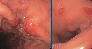 What to expect during an upper endoscopy? Endoscopy Campus Image Galleries