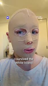 I lost my fingers to a volcano 🌋