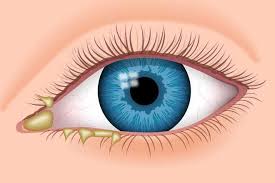 Image result for Eye Discharge