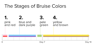 Home remedies to get rid of bruises fast mouthwash. How To Heal A Bruised Face Medical Treatments And Home Remedies