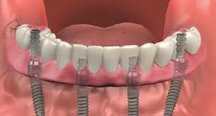 Some minor treatments are free. What Are Full Mouth Dental Implants And What Do They Cost Teethxpress