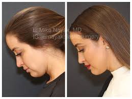 TOTAL TRANSFORMATION over the course of 2 years using Surgical and  Non-Surgical Treatments. FIRST collage: showcasing this patients complete  transformation. 2 years ago, before her rhinoplasty, buccal fat removal or  any Non-Surgical