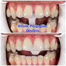 We have recently moved on to become a complete primary care facility by investing in state of the art diagnostic equipments. Klinik Pergigian Qistina Close Ur Teeth Gap With Us Klinikpergigianqistina Teethgap Gigijarang Gigicantik Gigiputih Crowning Smilesofmalaysia Aestheticdentistry Dentist Dentalmakeover Whitening Teethwhitening Doktorgigi