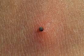 Insecta pe care o produce platanul, tigrul a crescut mare, atacă. Category Montgomery Cold Saltea Inteapa Insecta Hardwoodflooringspecialist Net