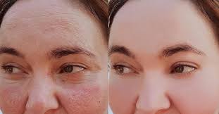 Vitamin k is a vitamin found in leafy green vegetables, broccoli, and brussels sprouts. Treating Rosacea Vitamin K Vitamin C A Wordpress Site