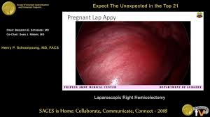Patients with endometriosis do not frequently have any physical examination findings beyond tenderness related to laparoscopy is considered the primary diagnostic modality for endometriosis. Expect The Unexpected Laparoscopic Appendectomy From The Sages Video Library