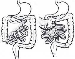Image result for Midgut Volvulus