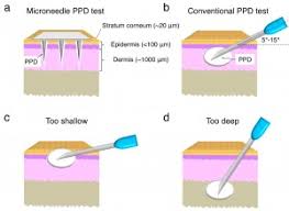 Gummas are cold abscesses that will develop at. Microneedle Patch Could Replace Standard Tuberculosis Skin Test