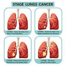 Symptoms of lung cancer develop as the condition progresses. Lung Cancer Causes Symptoms And Treatment In Bangalore