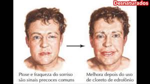 La corporación miastenia gravis de chile (santiago), se creó para ayudar a quienes padecen esta enfermedad ( debilidad muscular ). Miastenia Grave Youtube