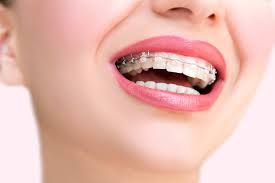 For example, aligners are removable which means a user can remove aligners while eating or drinking. Pristine Orthodontics Pristine Dental Centre Kuala Lumpur Petaling Jaya Malaysia