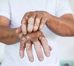 Image result for Vitiligo