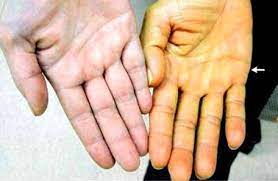 In some cases, an advil overdose can be fatal. How Many Advil Pills Can You Take To Get Hospitalized But Not Killed Quora