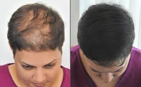 Art On The Faces By Siluet Estetik Scalp Micro Pigmentation Sac Simulasyonu Cabelo Curto Pigmentacao Cabelo