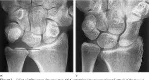 Ulnar Shortening Osteotomy With A Standard Technique. | Download Scientific  Diagram