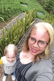 Boy with two-tone skin is now a model — and it runs in the family