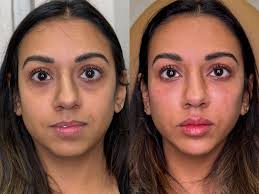 Injectables: Tox & Fillers