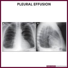 Chest X Ray Chest Radiography Nurse Study Guide Radiography Nursing Study Guide Pleural Effusion