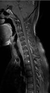 Spinal Epidural Hematoma Radiology Reference Article Radiopaedia Org
