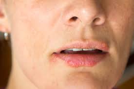 Lippenentzundungen Und Ekzemeapotheken Wissen De