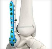 Lateral Fibula Plates - Unite Foot and Ankle