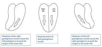 Carotid Artery Dissection Causing An Isolated Hypoglossal Nerve Palsy
