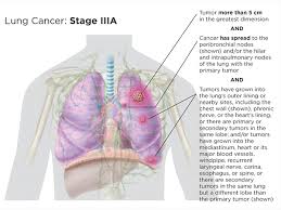 Lung Cancer Staging Lungevity Foundation