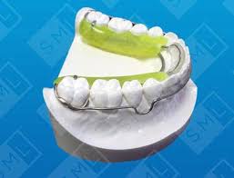 The total cost of inman aligner clear braces treatment can also depend on your initial assessment. Inman Aligner Sml