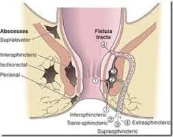 Image result for Ischiorectal Abscess