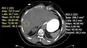 Current Status Of Imaging In Nonalcoholic Fatty Liver Disease
