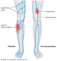 Tromboza venoasă renală este ocluzia (comprimarea) a uneia sau mai multor vene care penetrează rinichiul. Tromboflebitis Zapaljenje Povrsinskih Vena I Flebotromboza Tromboza Dubokih Vena