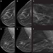 This can make it harder for your radiologist to spot signs of breast cancer, since dense tissue and tumors both look white in mammogram images. Tomosynthesis With Synthetic Mammography Improves Breast Cancer Detection Eurekalert Science News