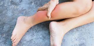 Pembengkakan di kaki setelah keseleo. Rasa Kebas Kaki Perkara Biasa Atau Tanda Penyakit Hello Doktor