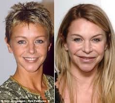 Image Result For Plastic Surgery Gone Too Far Celebrity Plastic Surgery Plastic Surgery Plastic Surgery Fail