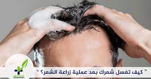 كيف يتم غسل الشعر بعد عملية زراعة الشعر