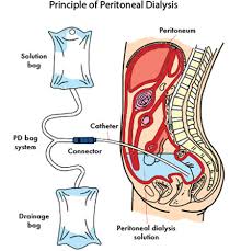 Peritoneal Dialysis Pd Dialysis The National Kidney