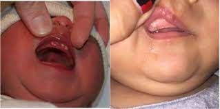 Berikut penyebab munculnya bercak putih di kemaluan pria selengkapnya. Bintik Putih Pada Gusi Bayi Macam Benjolan Perlukah Saya Risau Theasianparent Malaysia